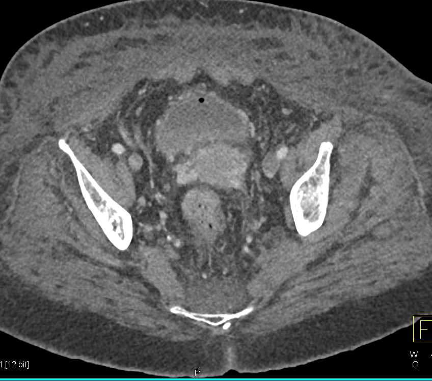 Gastric GIST Tumor with Carcinomatosis - CTisus CT Scan