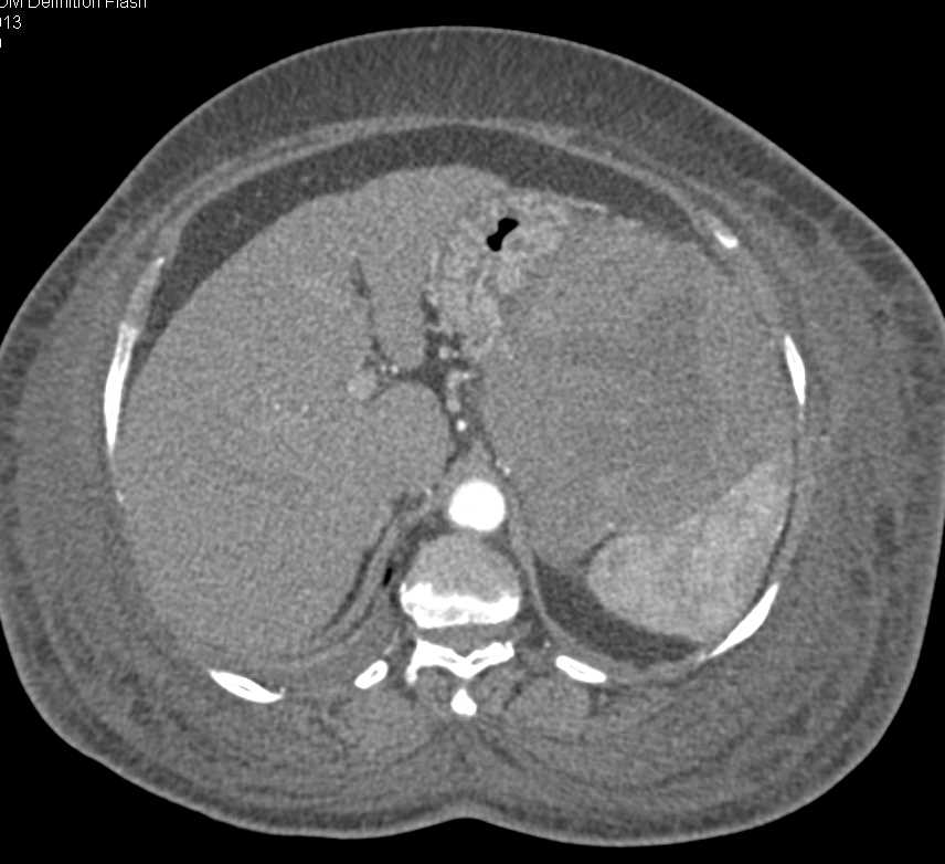 Gastric GIST Tumor with Carcinomatosis - CTisus CT Scan