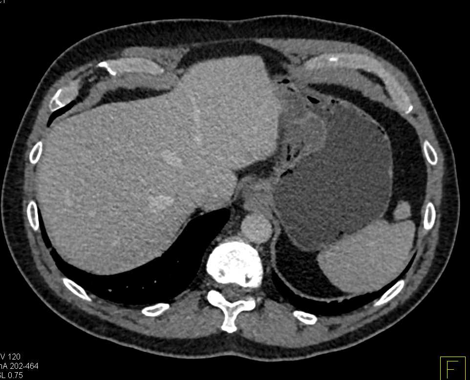 Gastric Adenocarcinoma - CTisus CT Scan