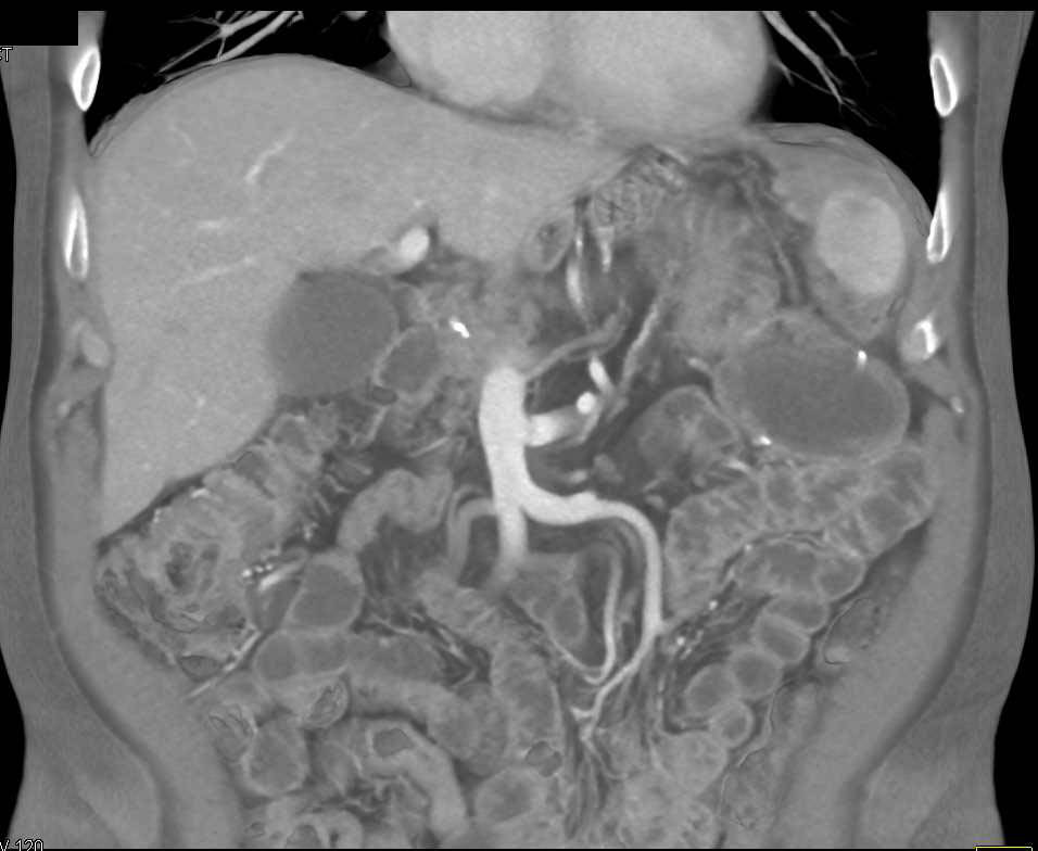 Recurrent Gastric Cancer Involves the Spleen - CTisus CT Scan