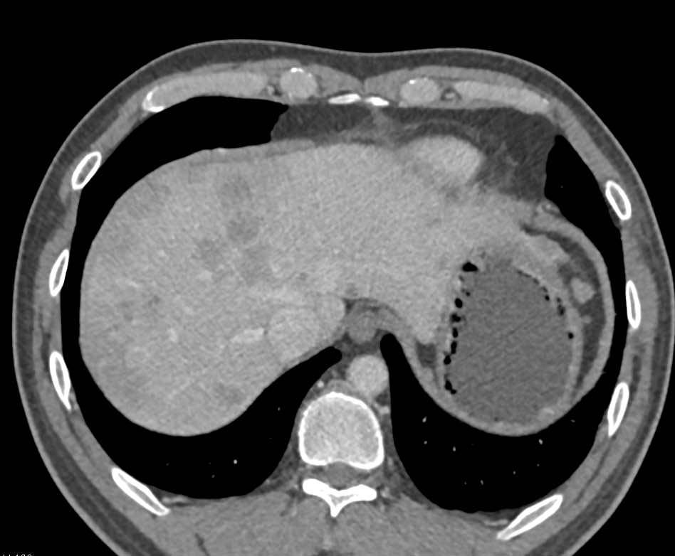 Recurrent Gastric Cancer with Liver Metastases - CTisus CT Scan