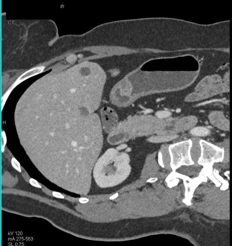 Leiomyoma in Gastric Antrum - CTisus CT Scan