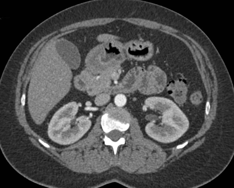 Gastric Antral Carcinoma - CTisus CT Scan