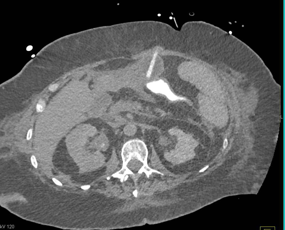 G-Tube with a Leak - CTisus CT Scan