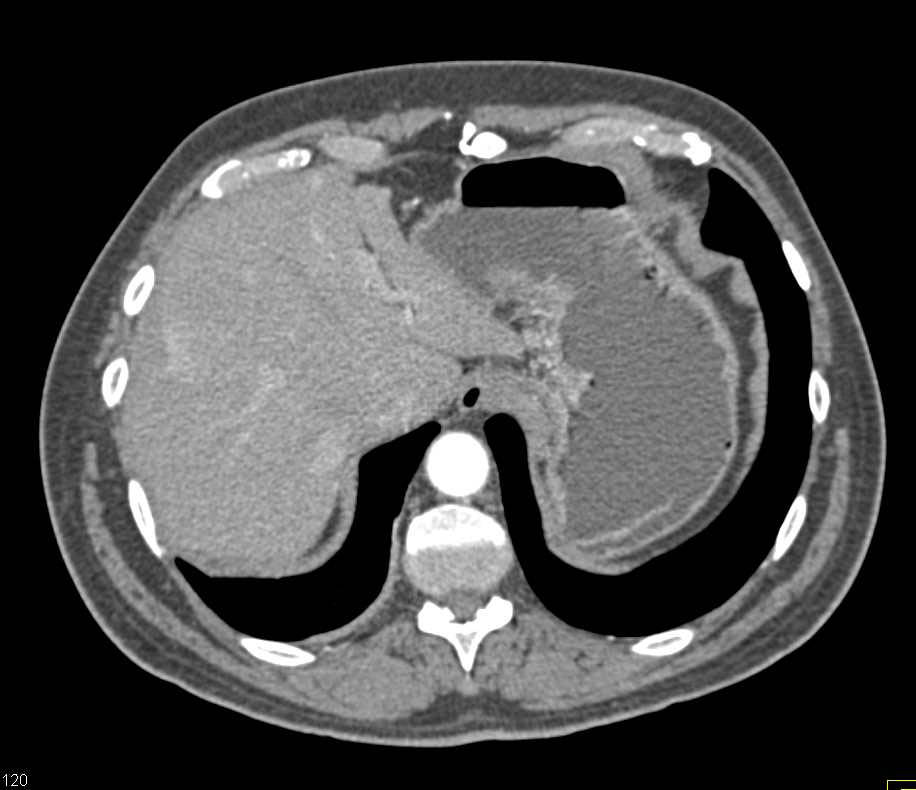 Carcinoma of the Gastroesophageal (GE) Junction with Adenopathy in Celiac Nodal Chain - CTisus CT Scan