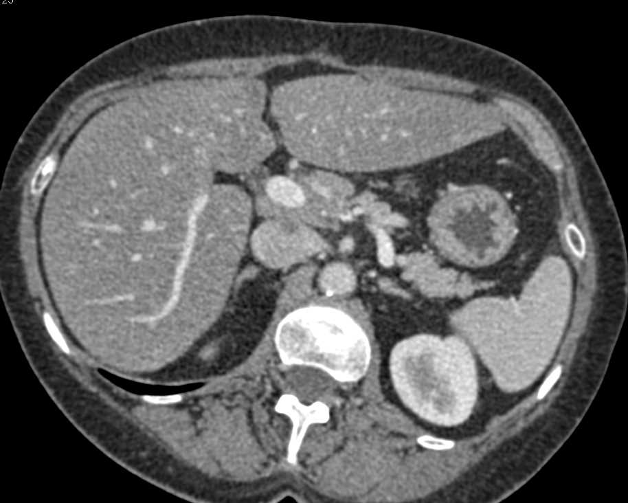 Linitis Plastica Infiltrating the Stomach - CTisus CT Scan