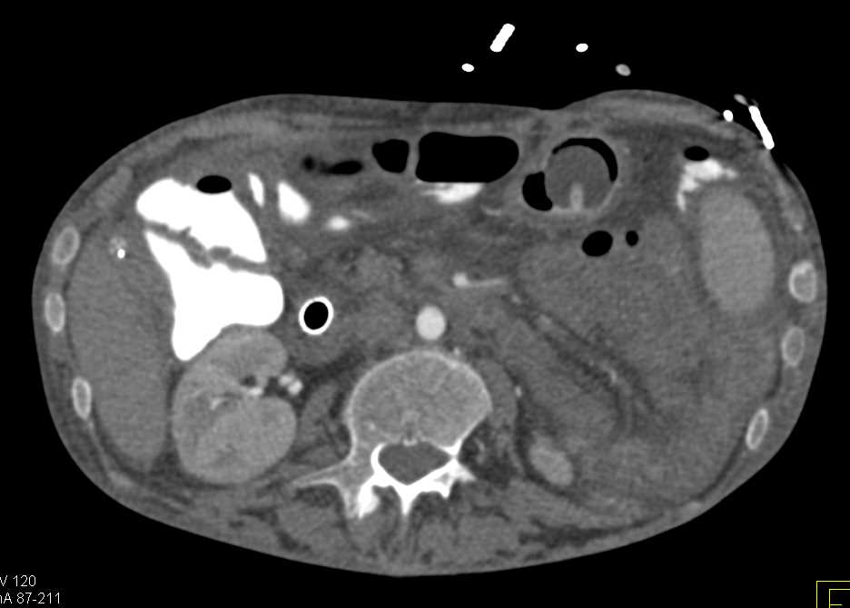 G-Tube in Patient with Pancreatic Cancer - CTisus CT Scan