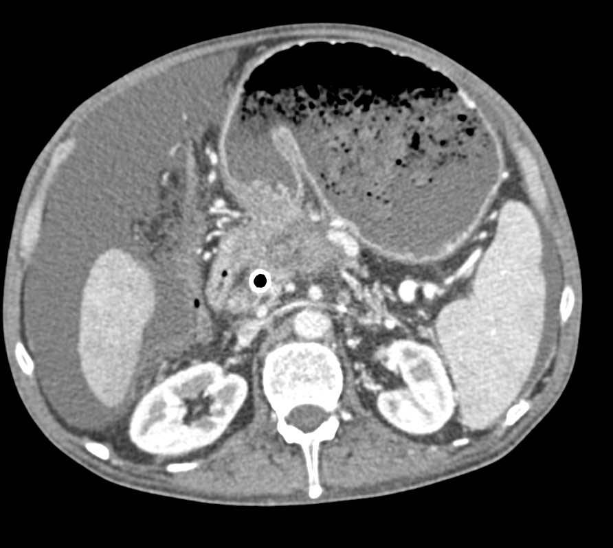 Pancreatic Cancer Causes Gastric Outlet Obstruction - CTisus CT Scan