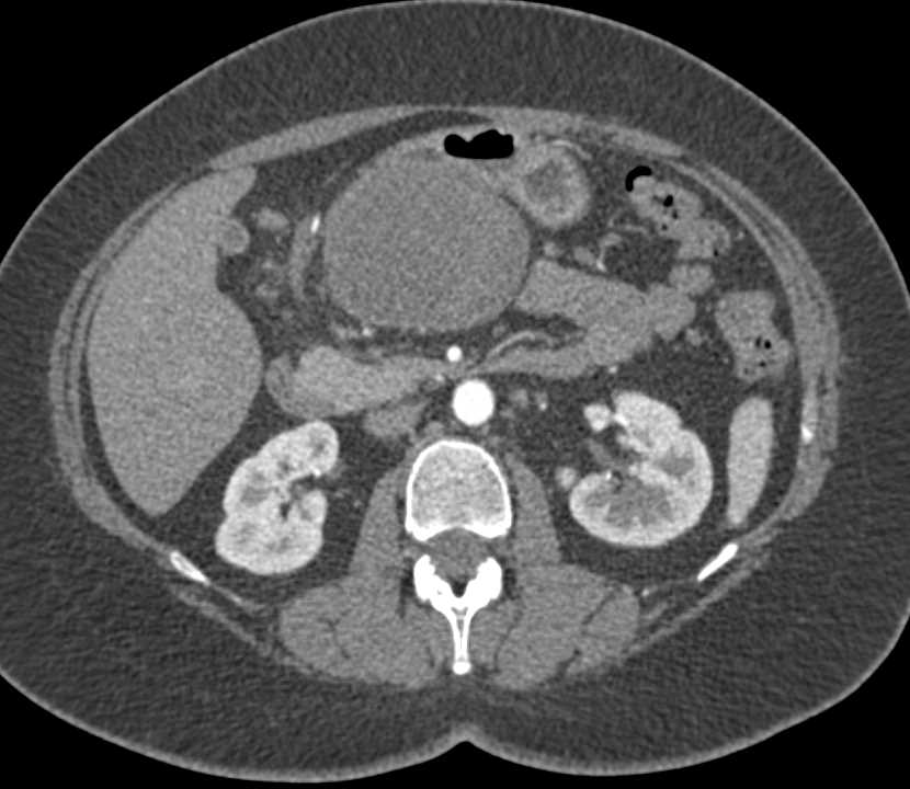 Gastric GIST Tumor - CTisus CT Scan