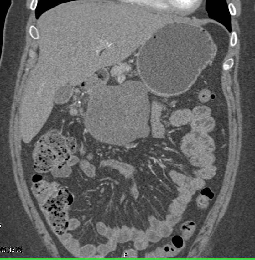 Gastric GIST Tumor - CTisus CT Scan