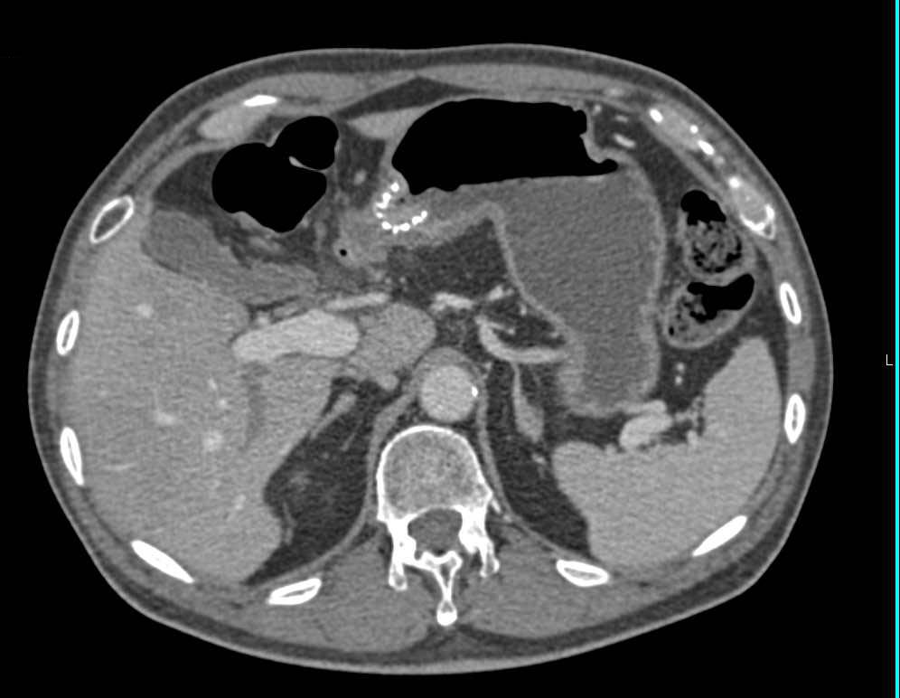 Stent in Gastric Antrum - CTisus CT Scan