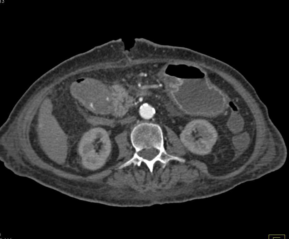 Gastritis in an Immunosuppressed Patient - CTisus CT Scan