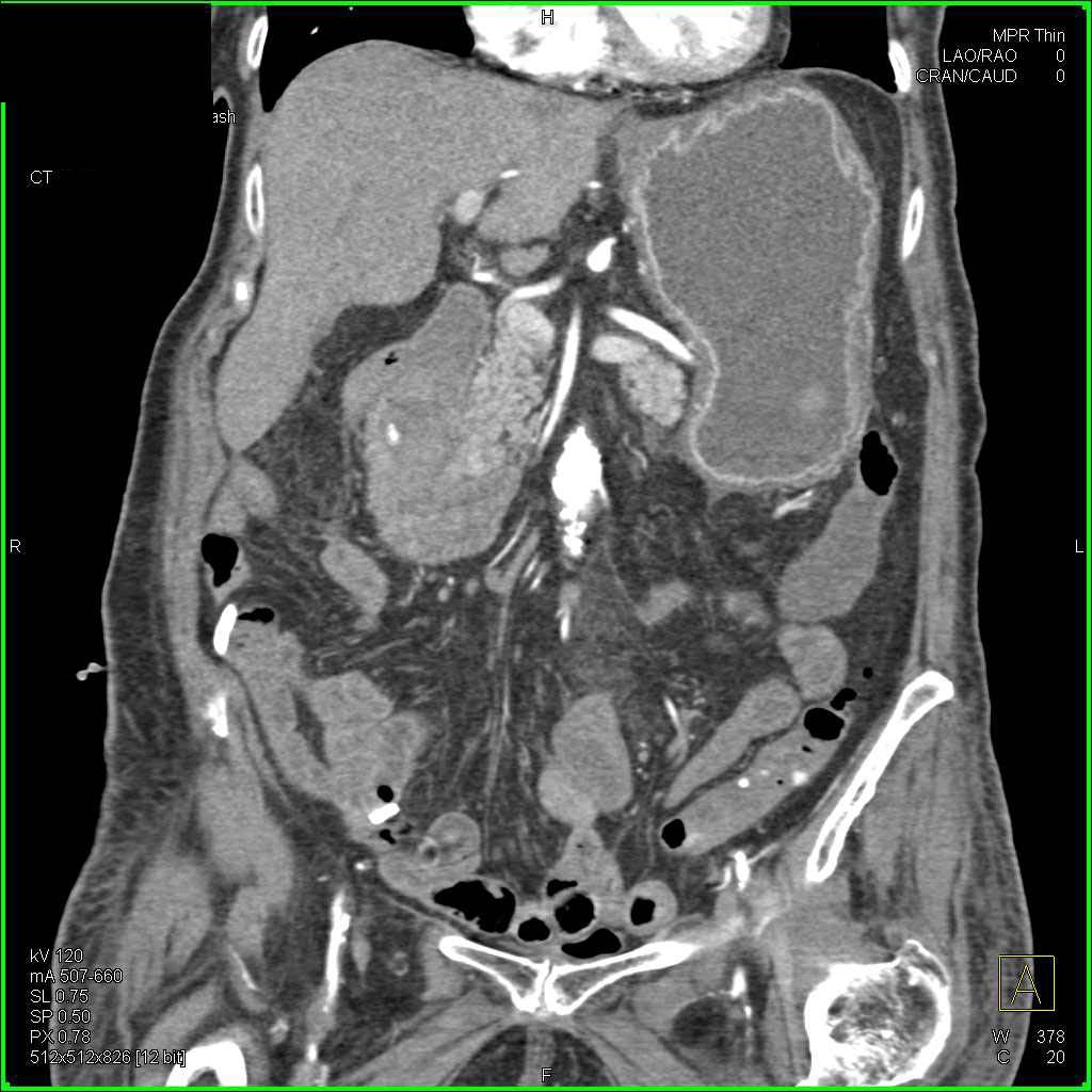 Gastritis in an Immunosuppressed Patient - CTisus CT Scan