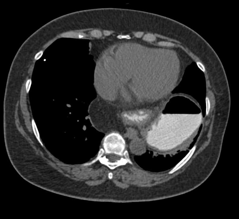 Gastric Volvulus - CTisus CT Scan