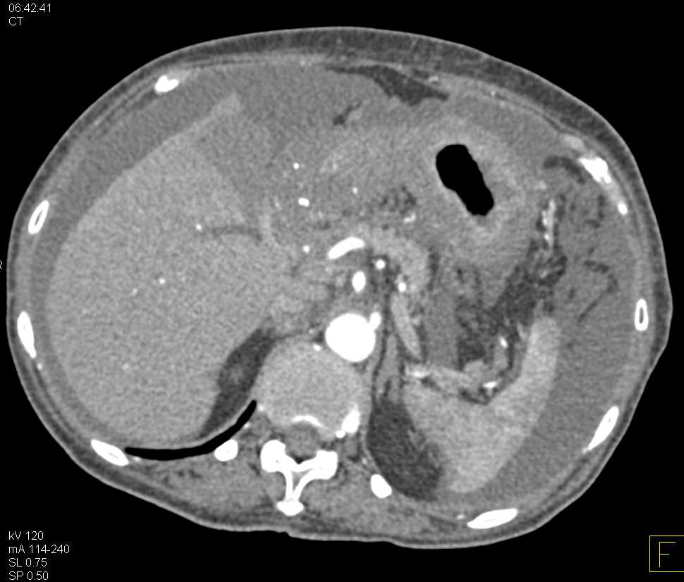 Linitis Plastica Stomach with Carcinomatosis - CTisus CT Scan