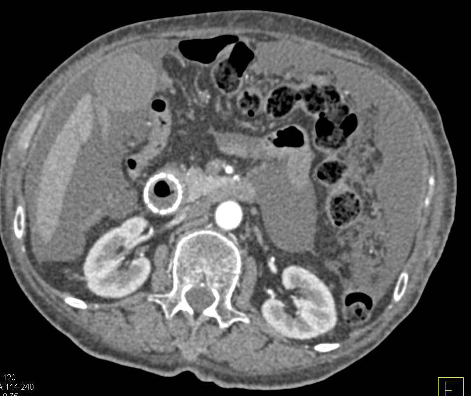 Linitis Plastica Stomach with Carcinomatosis and Stent in Antrum into Duodenum - CTisus CT Scan