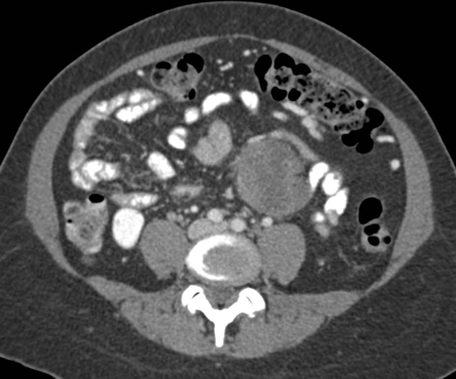 GIST of the Stomach with Adenopathy - CTisus CT Scan