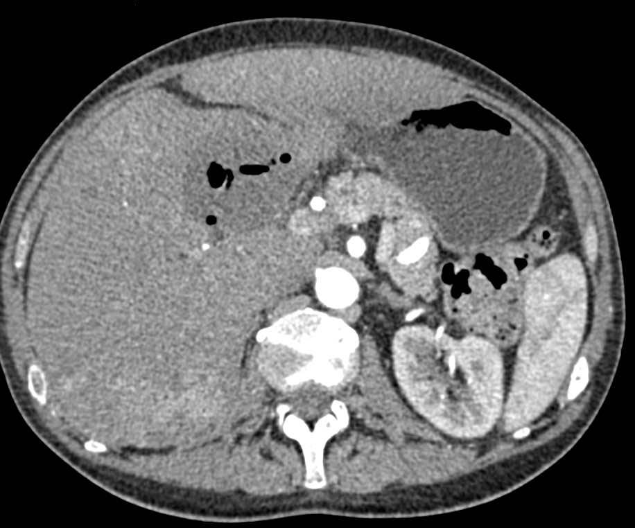 Carcinoma of the Gastric Antrum with Liver Metastases - CTisus CT Scan