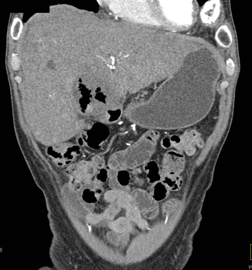 Ulcerating Carcinoma of the Gastric Antrum with Liver Metastases - CTisus CT Scan