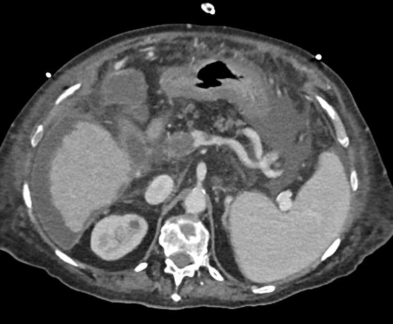 Gastric Adenocarcinoma with Carcinomatosis - CTisus CT Scan