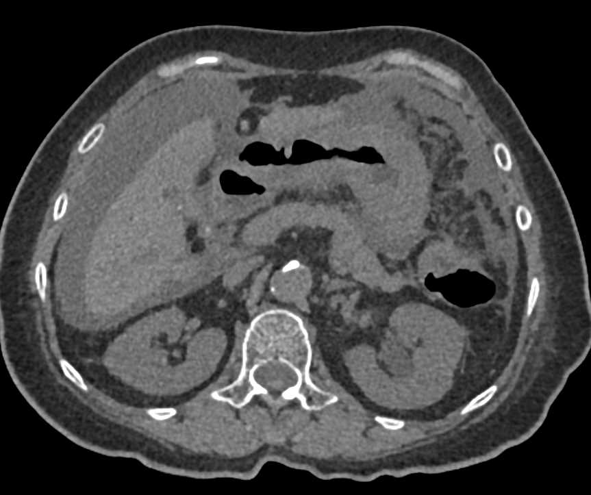 Gastric Cancer with Carcinomatosis - CTisus CT Scan