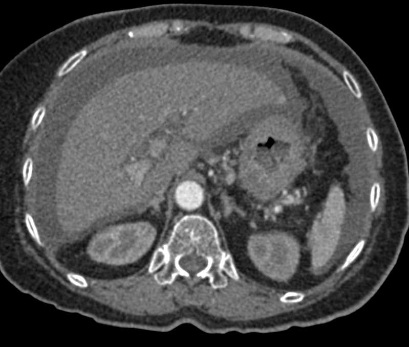 Gastric Cancer with Carcinomatosis - CTisus CT Scan