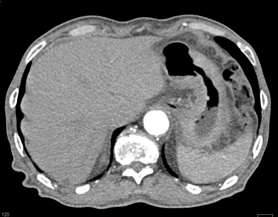 Linitis Plastica with Gastric Cancer and Liver Metastases - CTisus CT Scan