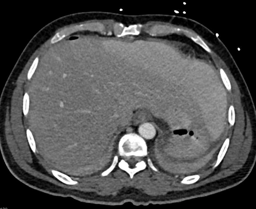 Pneumoperitoneum Following G-Tube Placement - CTisus CT Scan