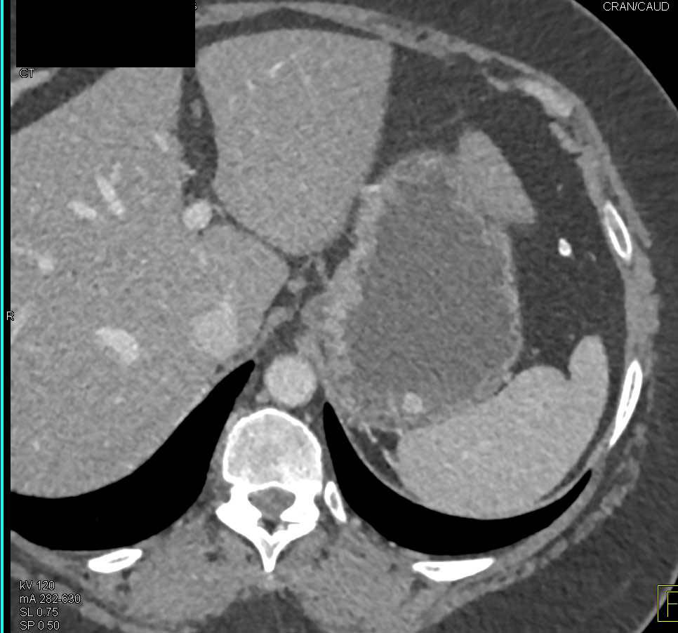 Vascular Metastases from the Kidney to the Stomach - CTisus CT Scan