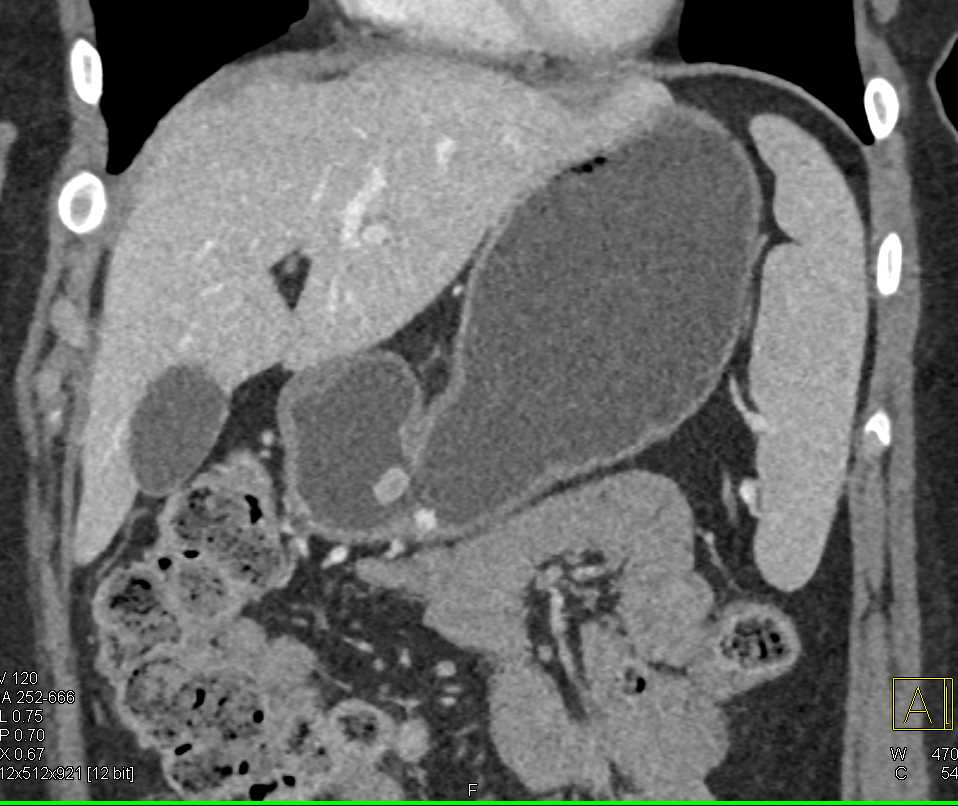 Carcinoid Tumor in the Gastric Antrum - CTisus CT Scan