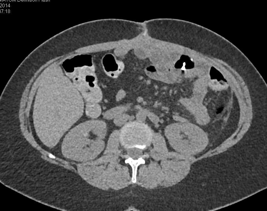 Patient Swallowed Multiple Safety Pins - CTisus CT Scan