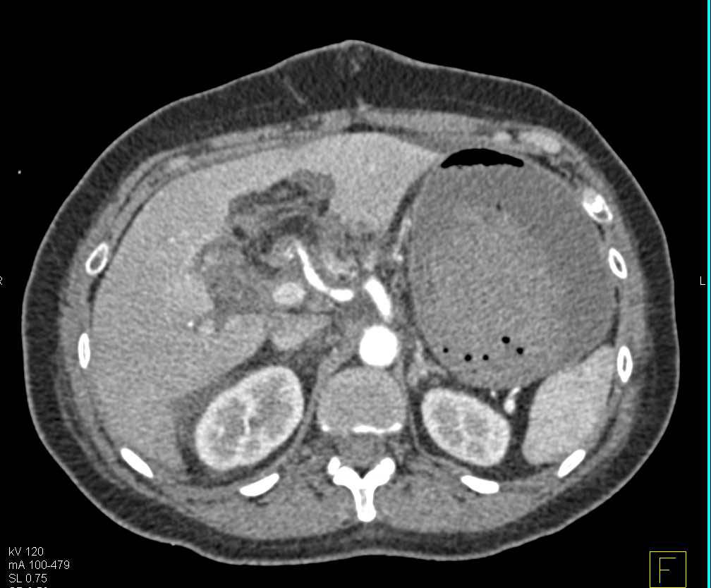 Active Gastric Bleed s/p Whipple Procedure - CTisus CT Scan