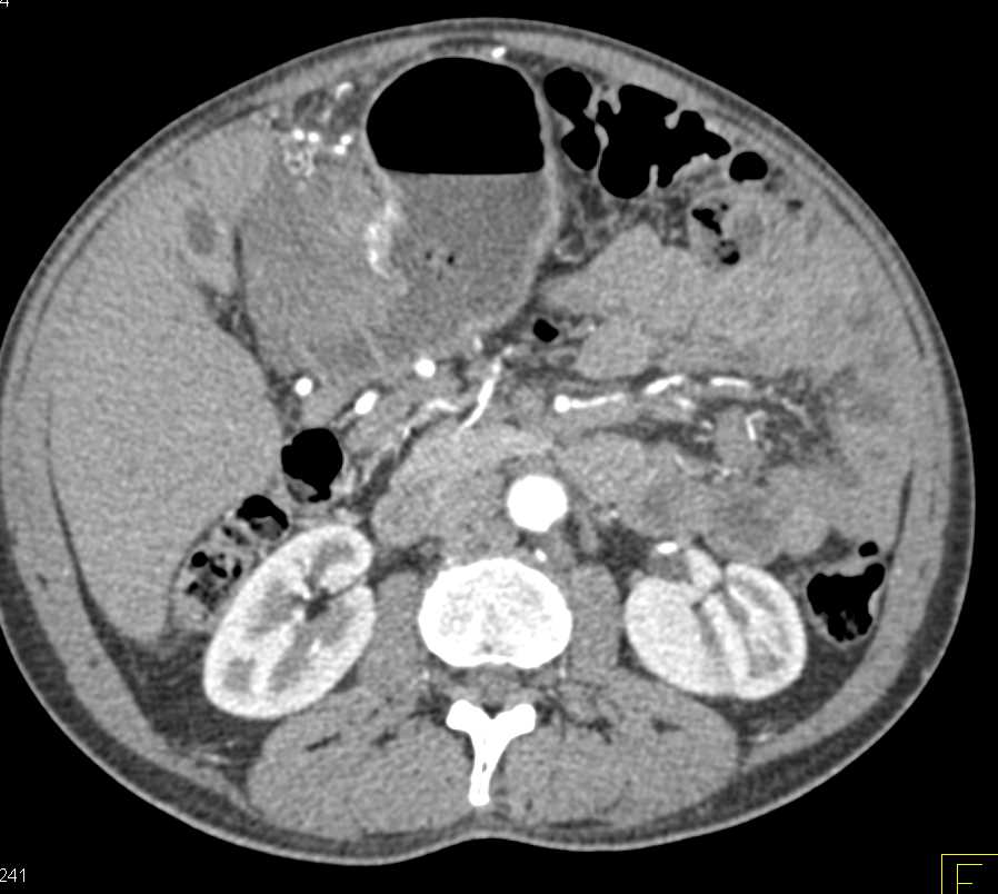 Invasive Gastric GIST Tumor - CTisus CT Scan