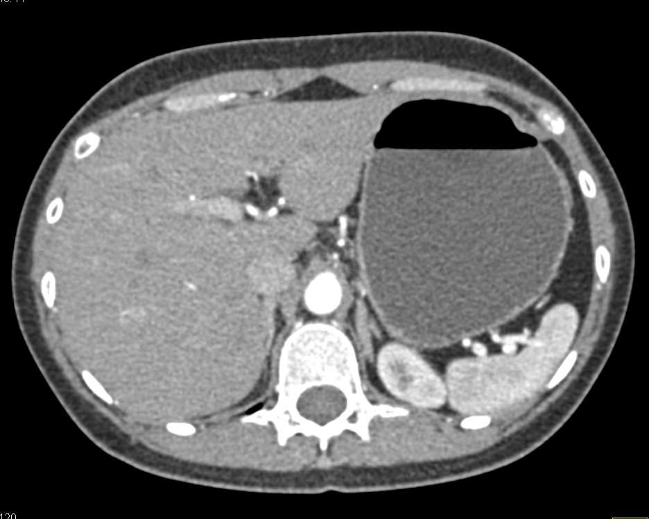 Antral Carcinoma - CTisus CT Scan