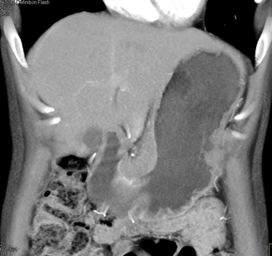 Antral Carcinoma with Ulceration - CTisus CT Scan