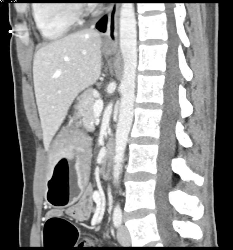 Antral Carcinoma with Ulceration with 3D Mapping - CTisus CT Scan