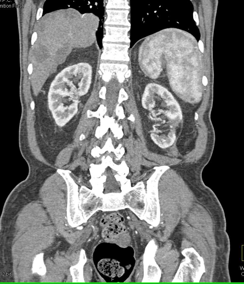 Gastric Cancer with Pseudomyxoma Peritonei (PMP) - CTisus CT Scan