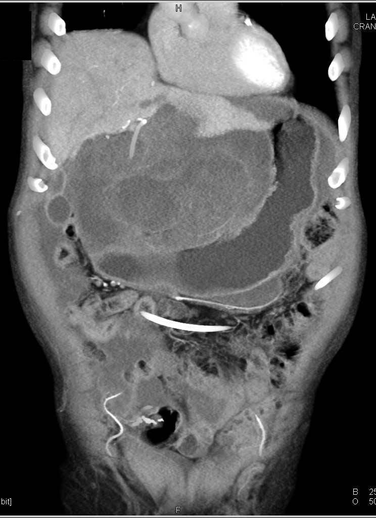 Gastric Cancer with Pseudomyxoma Peritonei (PMP) - CTisus CT Scan