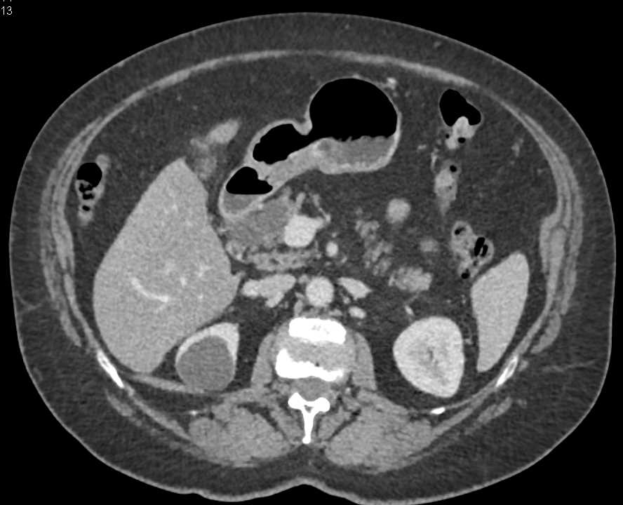 Polypoid Mass in Gastric Antrum - CTisus CT Scan