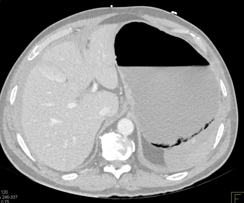 Emphysematous Gastritis - CTisus CT Scan