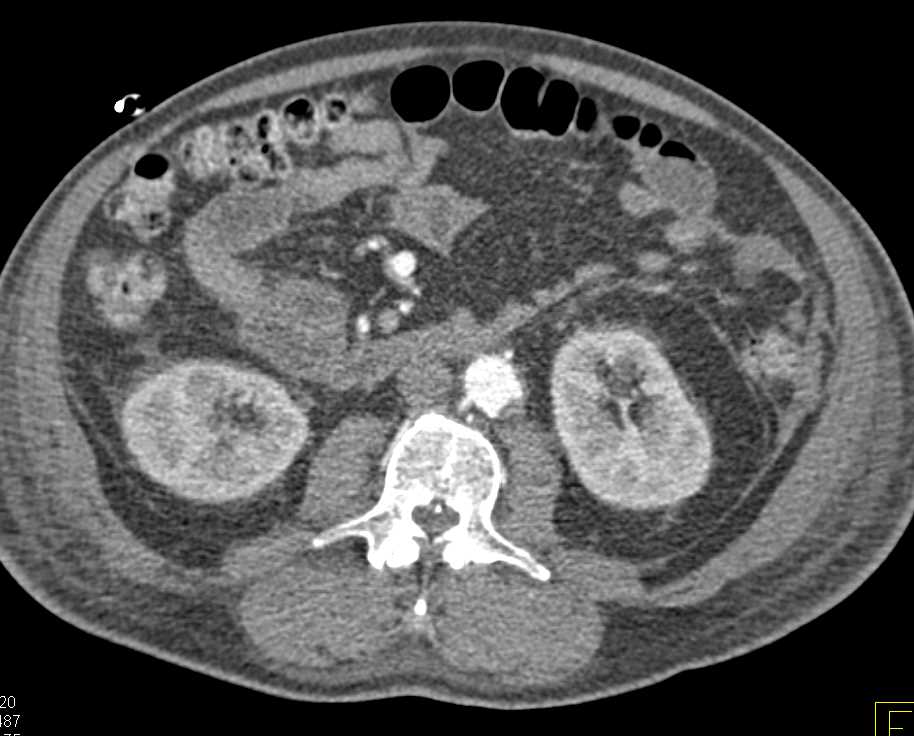 Emphysematous Gastritis - CTisus CT Scan