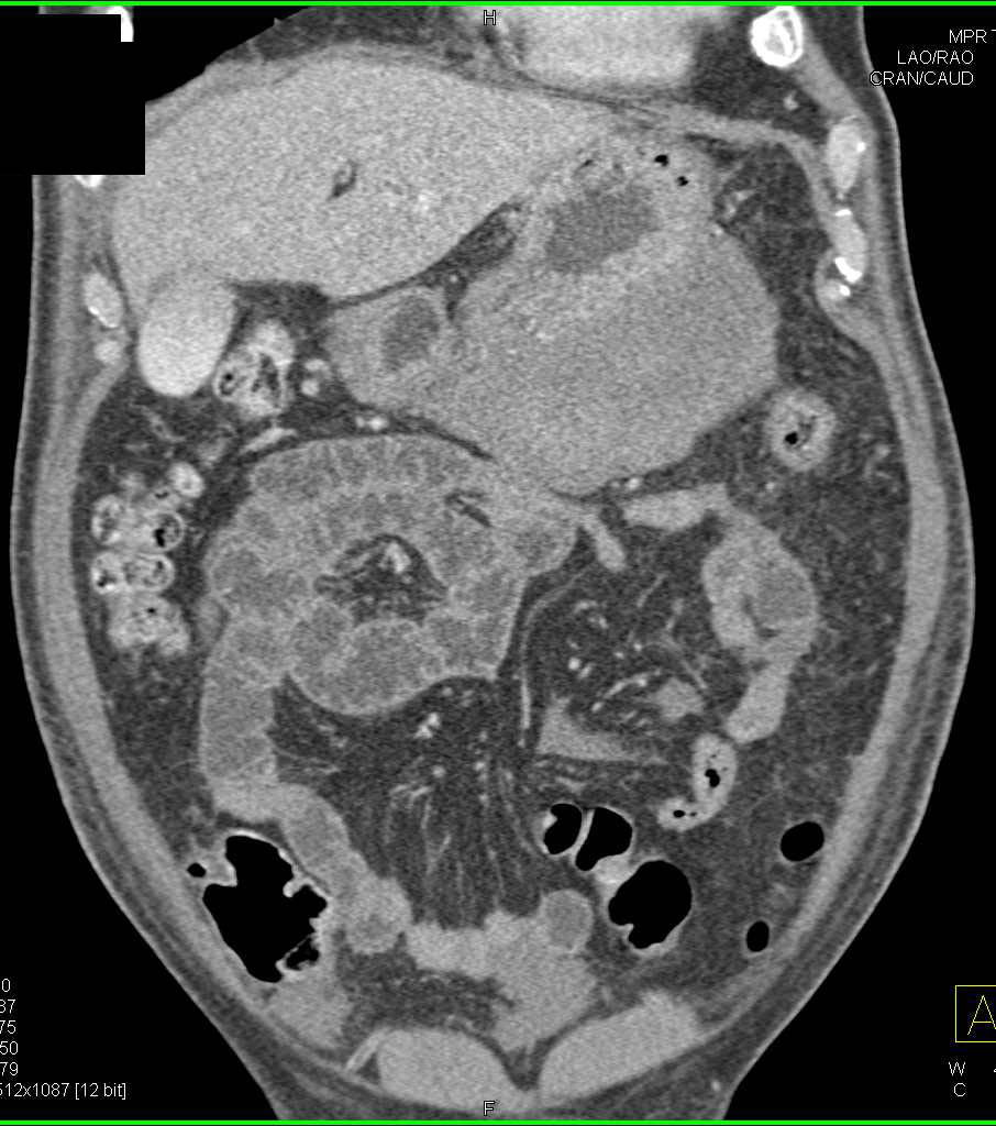 Emphysematous Gastritis - CTisus CT Scan