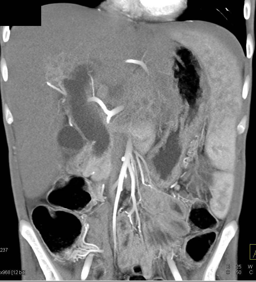 Gastric GIST Tumor with Carcinomatosis - CTisus CT Scan