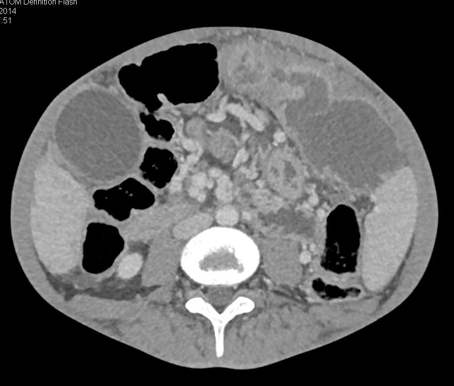 Ulcerating Gastric GIST Tumor - CTisus CT Scan