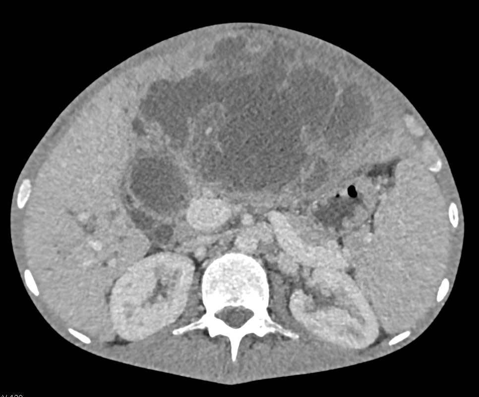 Ulcerating Gastric GIST Tumor - CTisus CT Scan