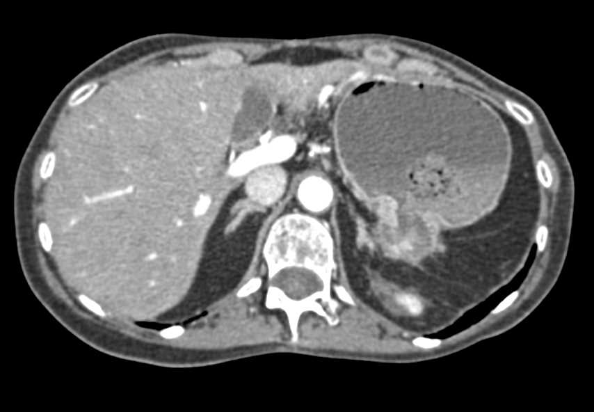 Perforation of Gastric Adenocarcinoma - CTisus CT Scan