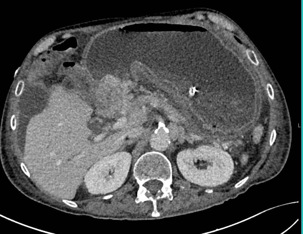 Carcinoma of the Gastric Antrum - CTisus CT Scan