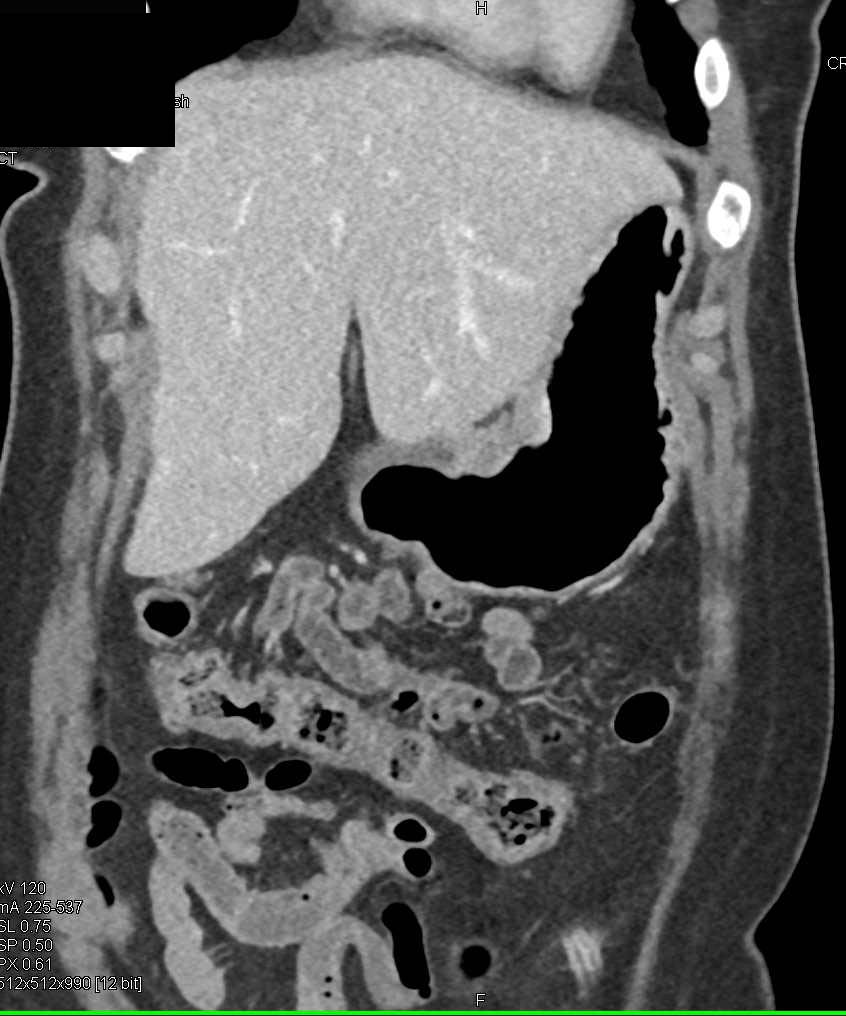 Ulcerating Gastric Cancer - Stomach Case Studies - CTisus CT Scanning