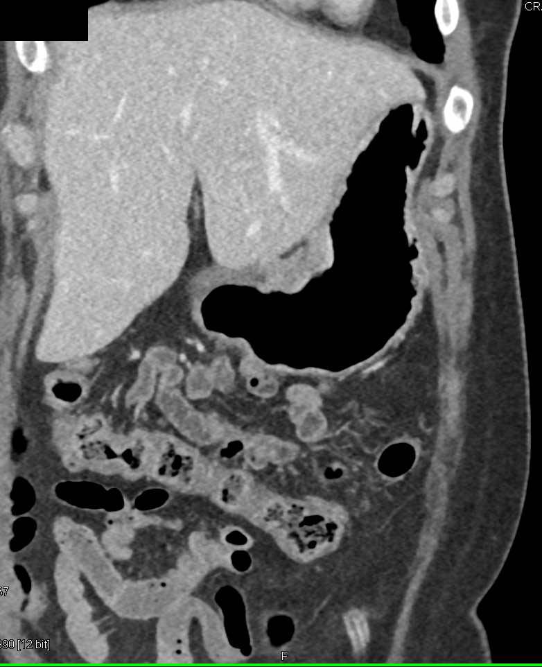 Ulcerating Gastric Cancer - CTisus CT Scan