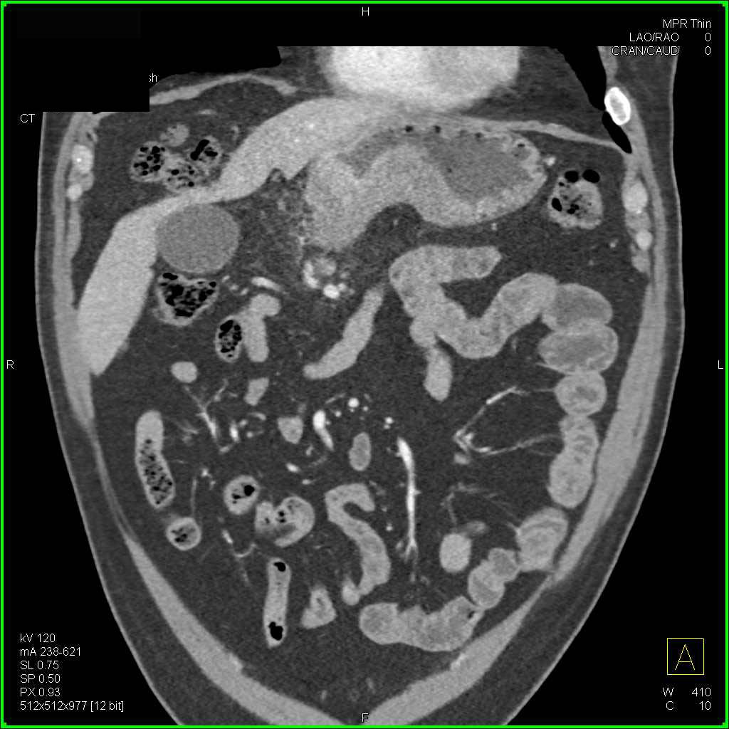 Gastric Adenocarcinoma in the Antrum with Local Adenopathy - CTisus CT Scan